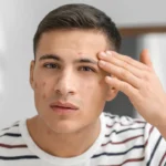 young-boy-worried-for-his-acne-face